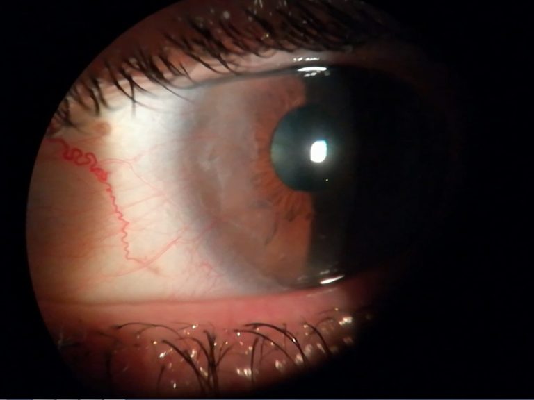 Primer plano de un ojo con un pterigion avanzado, llegando casi a la pupila.